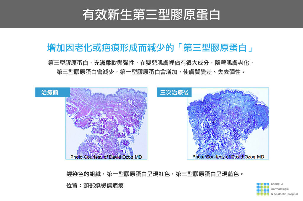 Up雷射ultrapulse汽化雷射雷射效果痘疤凹疤up雷射永和皮膚科林上立醫師上立皮膚科13.jpg Up雷射ultrapulse汽化雷射雷射效果痘疤凹疤up雷射永和皮膚科林上立醫師上立皮膚科13.jpg