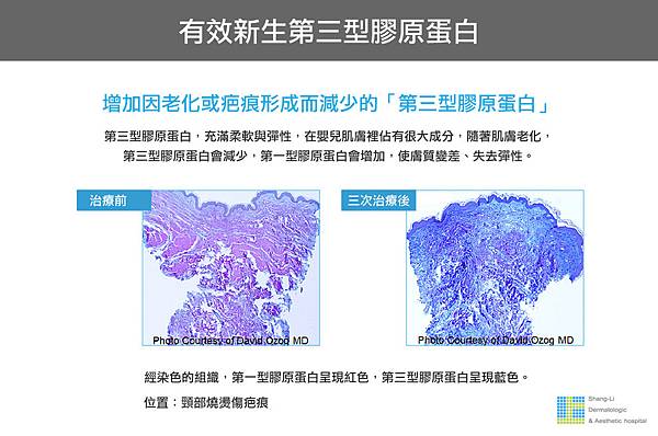 Up雷射ultrapulse汽化雷射雷射效果痘疤凹疤up雷射永和皮膚科林上立醫師上立皮膚科13.jpg