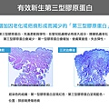Up雷射ultrapulse汽化雷射雷射效果痘疤凹疤up雷射永和皮膚科林上立醫師上立皮膚科13.jpg