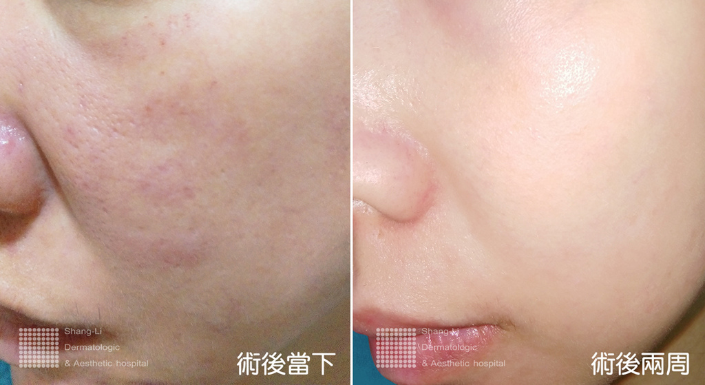 PicoSure755皮秒雷射蜂巢式雀斑曬斑除斑痘疤台北皮秒雷射推薦醫師皮膚科醫師痘疤凹疤飛梭雷射皮秒雷射價格副作用除斑凹洞淨膚雷射防曬推薦防曬乳曬黑紫外線4.jpg