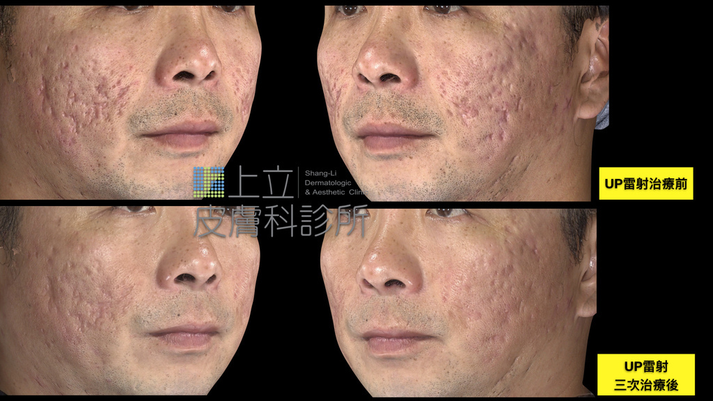 PicoSure755皮秒雷射蜂巢式雀斑曬斑除斑痘疤台北皮秒雷射推薦醫師皮膚科醫師痘疤凹疤飛梭雷射皮秒雷射價格副作用除斑凹洞淨膚雷射防曬推薦防曬乳曬黑紫外線7.jpg