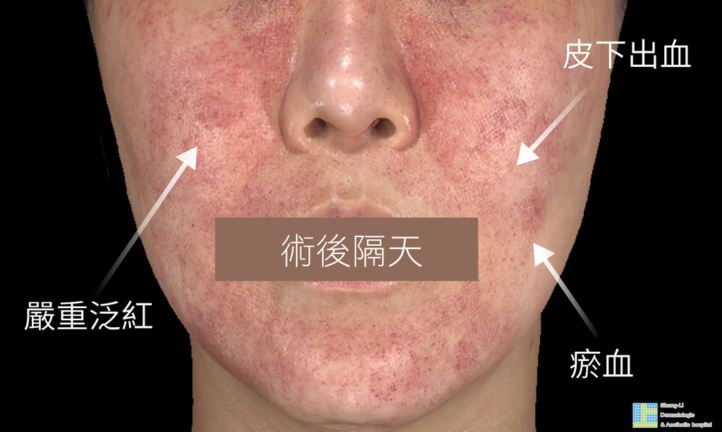 PicoSure755皮秒雷射蜂巢式雀斑曬斑除斑痘疤台北皮秒雷射推薦醫師皮膚科醫師痘疤凹疤飛梭雷射皮秒雷射價格副作用除斑凹洞淨膚雷射防曬推薦防曬乳曬黑紫外線03.jpg PicoSure755皮秒雷射蜂巢式雀斑曬斑除斑痘疤台北皮秒雷射推薦醫師皮膚科醫師痘疤凹疤飛梭雷射皮秒雷射價格副作用除斑凹洞淨膚雷射防曬推薦防曬乳曬黑紫外線03.jpg