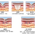 舒顏萃sculptra3D聚左旋乳酸塑然雅童顏針淚溝液態拉皮作用價格副作用效果淚溝按摩法令紋PLLA林上立上立皮膚科診所推薦醫師一瓶幾CC舒顏萃玻尿酸台北推薦 (3).jpg