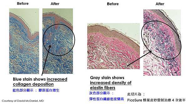 PicoSure755皮秒雷射蜂巢式雀斑曬斑除斑痘疤台北皮秒雷射推薦醫師皮膚科醫師痘疤凹疤飛梭雷射皮秒雷射價格副作用除斑凹洞淨膚雷射防曬推薦防曬乳曬黑紫外線(6).jpg