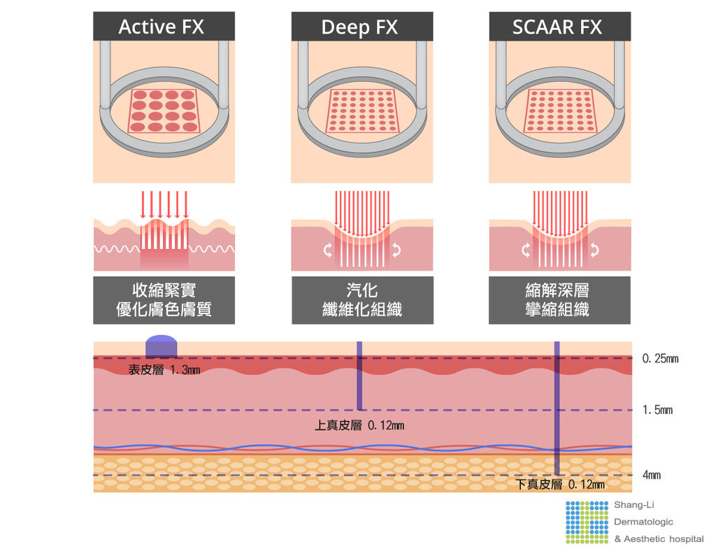 Up雷射ultrapulse汽化雷射雷射效果痘疤凹疤光老化治療副作用費用價錢up雷射永和皮膚科up雷射恢復期痘疤ppt林上立醫師上立皮膚科 (4).jpg