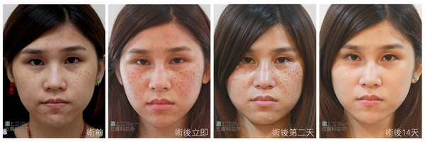 PicoSure755皮秒雷射蜂巢式雀斑曬斑除斑痘疤台北皮秒雷射推薦醫師皮膚科醫師痘疤凹疤飛梭雷射皮秒雷射價格副作用除斑凹洞淨膚雷射防曬推薦防曬乳曬黑紫外線 (2).jpg PicoSure755皮秒雷射蜂巢式雀斑曬斑除斑痘疤台北皮秒雷射推薦醫師皮膚科醫師痘疤凹疤飛梭雷射皮秒雷射價格副作用除斑凹洞淨膚雷射防曬推薦防曬乳曬黑紫外線 (2).jpg