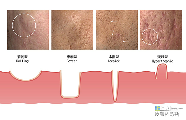 PicoSure755皮秒雷射蜂巢式痘疤台北皮秒雷射推薦醫師皮膚科醫師痘疤凹疤飛梭雷射皮秒雷射價格副作用Up雷射雷射效果 (4).png PicoSure755皮秒雷射蜂巢式痘疤台北皮秒雷射推薦醫師皮膚科醫師痘疤凹疤飛梭雷射皮秒雷射價格副作用Up雷射雷射效果 (4).png