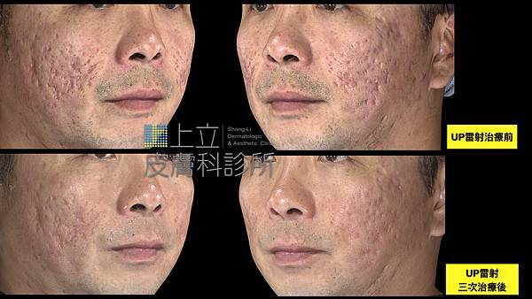 PicoSure755皮秒雷射蜂巢式痘疤台北皮秒雷射推薦醫師皮膚科醫師痘疤凹疤飛梭雷射皮秒雷射價格副作用Up雷射雷射效果 (2).jpg PicoSure755皮秒雷射蜂巢式痘疤台北皮秒雷射推薦醫師皮膚科醫師痘疤凹疤飛梭雷射皮秒雷射價格副作用Up雷射雷射效果 (2).jpg