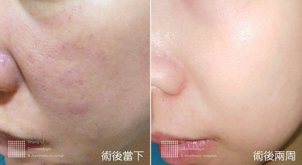 PicoSure755皮秒雷射蜂巢式痘疤台北皮秒雷射推薦醫師皮膚科醫師痘疤凹疤飛梭雷射皮秒雷射價格副作用Up雷射雷射效果 (3).jpg PicoSure755皮秒雷射蜂巢式痘疤台北皮秒雷射推薦醫師皮膚科醫師痘疤凹疤飛梭雷射皮秒雷射價格副作用Up雷射雷射效果 (3).jpg