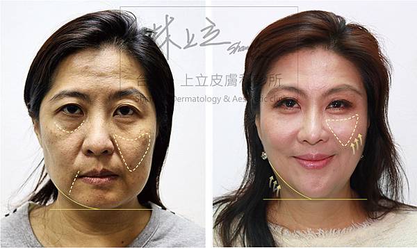 埋線拉提埋線拉提推薦埋線拉提價格埋線拉提效果埋線拉提維持多久5.jpg 埋線拉提埋線拉提推薦埋線拉提價格埋線拉提效果埋線拉提維持多久5.jpg