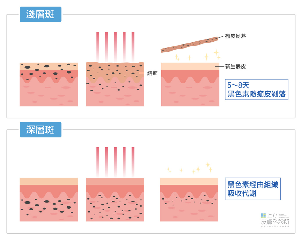 PicoSure755蜂巢皮秒雷射進行雷射除斑-依照斑點深度不一定會結痂-跟深淺層斑黑色素在皮膚的深度和代謝有關