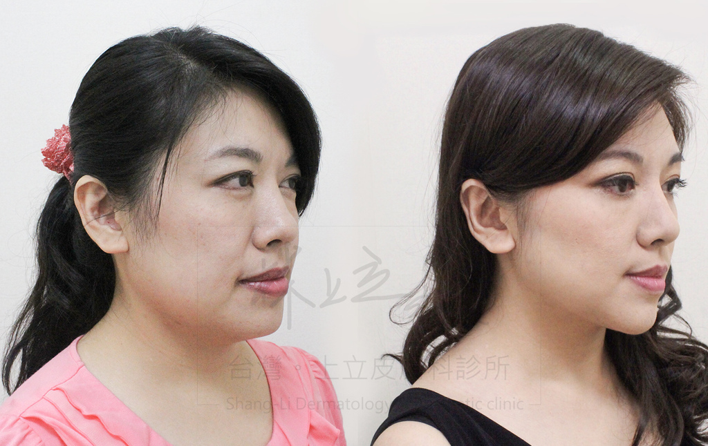 01-Double-chin-doctor-ShangLi-dermatologic-aesthetic-clinic (3).jpg