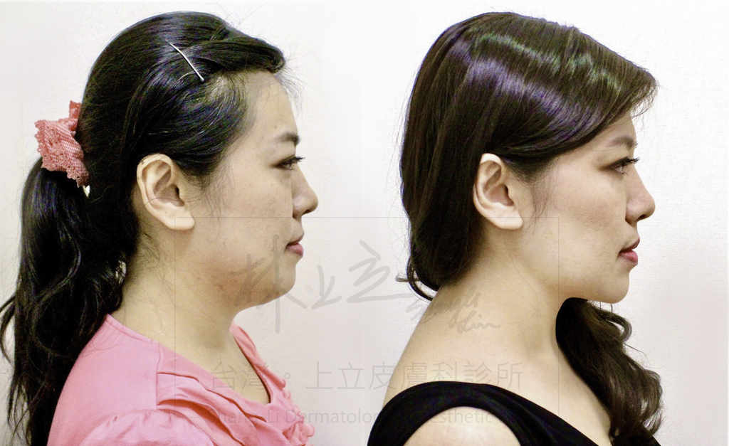 01-Double-chin-doctor-ShangLi-dermatologic-aesthetic-clinic (2).jpg