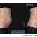 02-BA-fat-emsculpt-before-after-lslskin99-clinic.jpg