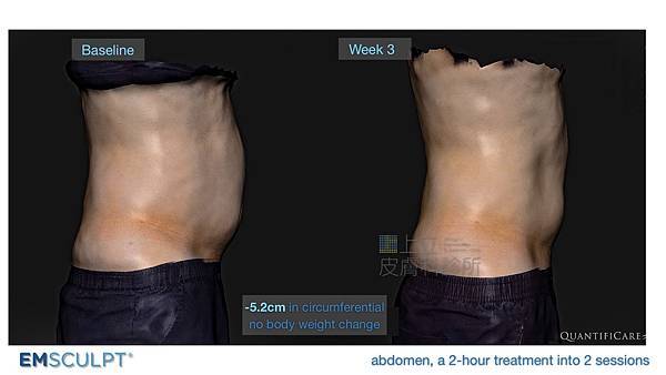 04-BA-fat-emsculpt-before-after-lslskin99-clinic.jpg.jpg