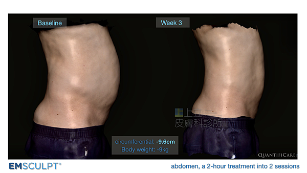 03-BA-fat-emsculpt-before-after-lslskin99-clinic.jpg.png