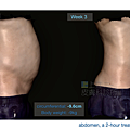 03-BA-fat-emsculpt-before-after-lslskin99-clinic.jpg.png