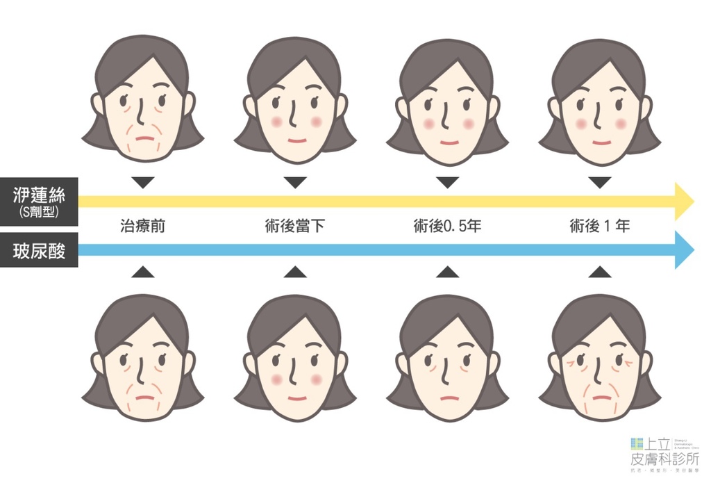 一樣都說是1年？但玻尿酸和洢蓮絲的差別在哪裡？02