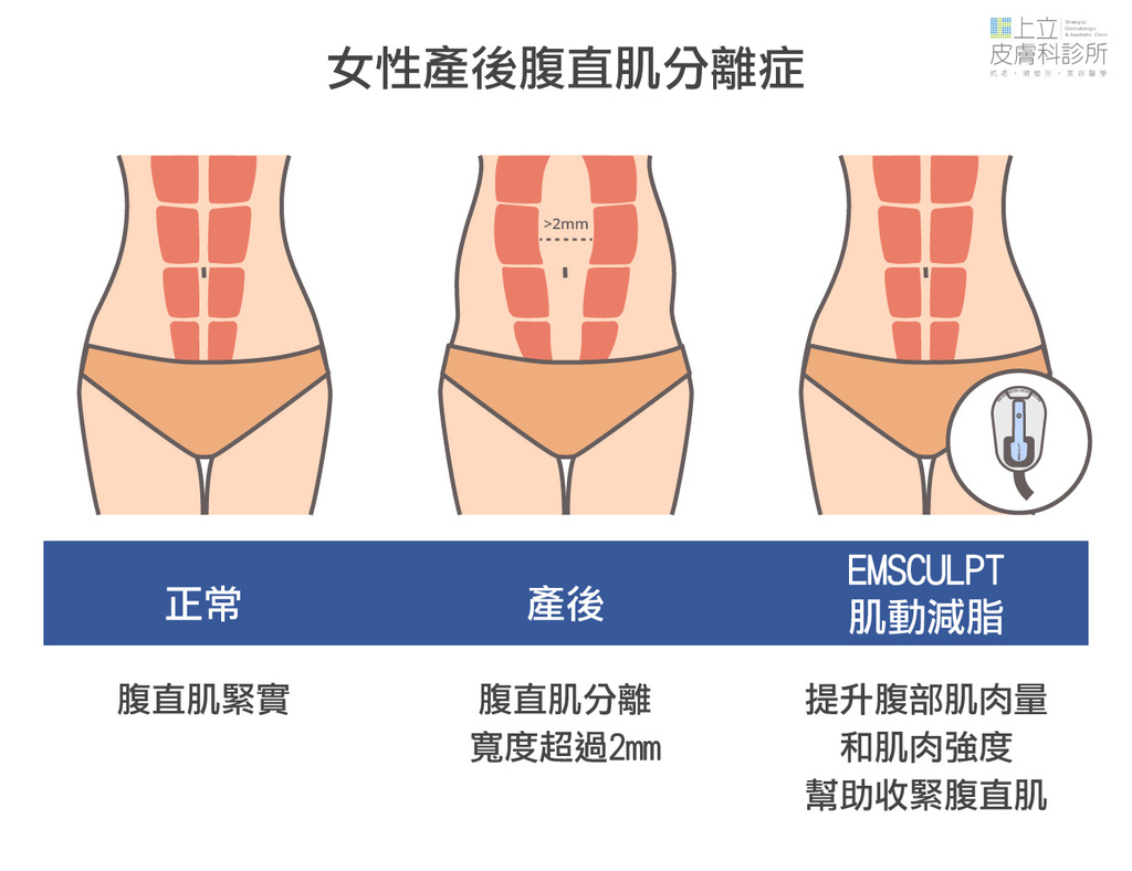 12-Postpartum-Rectus Abdominis Separation-Muscle.jpg