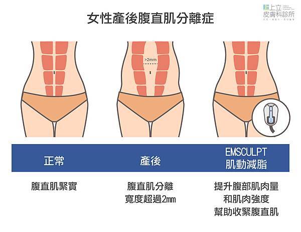 12-Postpartum-Rectus Abdominis Separation-Muscle.jpg