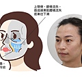 淚溝改善原因淚溝醫美玻尿酸玻尿酸淚溝維持舒顏萃洢蓮絲艾麗斯台北醫師推薦林上立醫師9.jpg