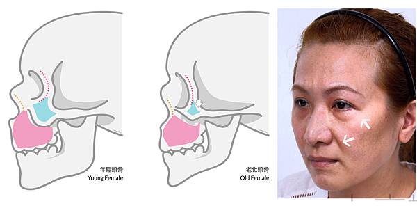 淚溝改善原因淚溝醫美玻尿酸玻尿酸淚溝維持舒顏萃洢蓮絲艾麗斯台北醫師推薦林上立醫師3.jpg