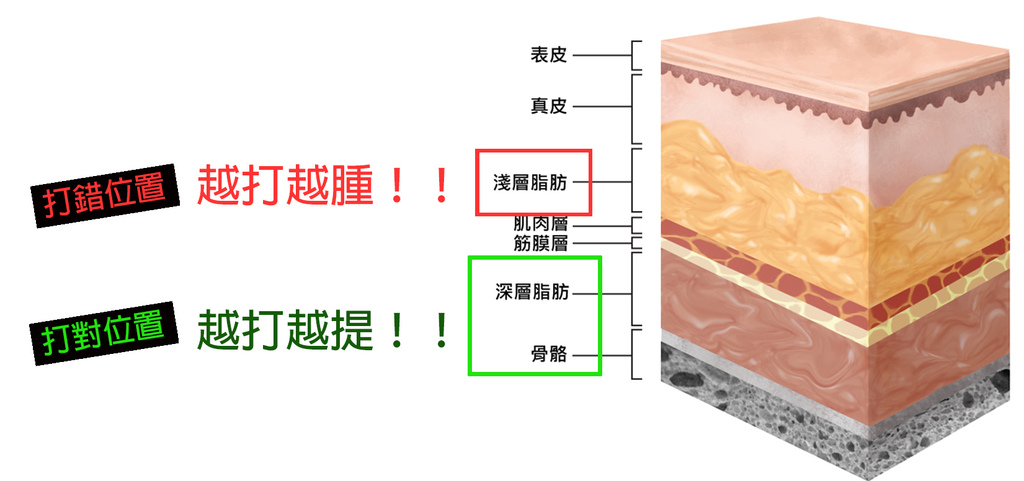 蘋果肌價錢蘋果肌凹陷下垂玻尿酸洢蓮絲舒顏萃膠原蛋白新生劑艾麗斯少女針精靈針林上立醫師推薦6.jpg