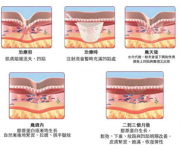 Ellanse-Sculptra-AestheFill-which-better Ellanse-Sculptra-AestheFill-which-better