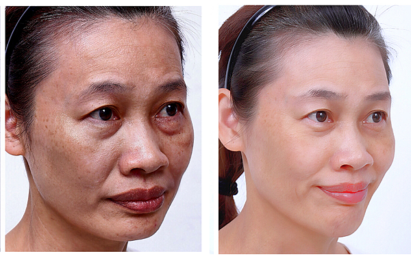 Ellanse-Sculptra-AestheFill-which-better Ellanse-Sculptra-AestheFill-which-better