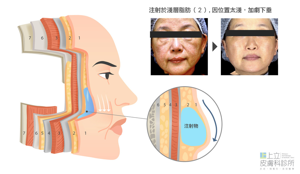 洢蓮絲注射的層次錯誤，造成臉部下垂更嚴重.jpg