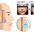 注射位置-錯誤.jpg