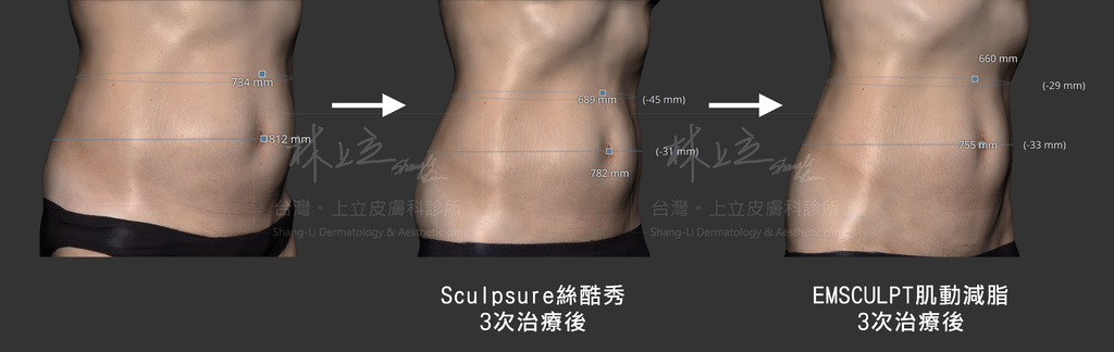 20200922_Emsculpt2.jpg