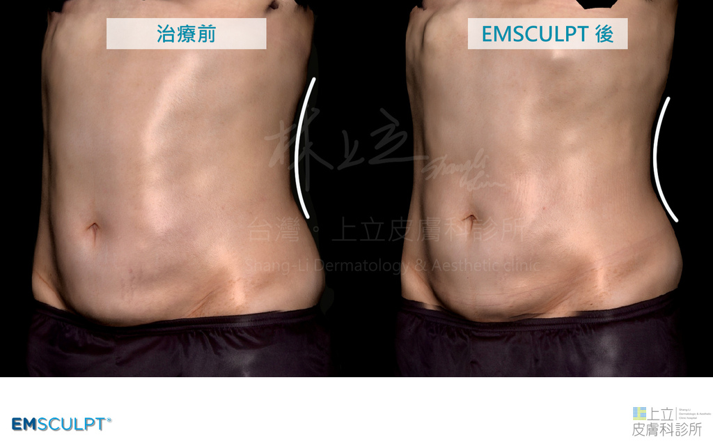 EMSCULPT肌動減脂提升腹部肌肉強度，緊實腹部、隱隱漏出腹部六塊肌、川字線，就連側腰的線條也更加明顯。