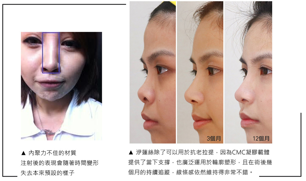 液態拉皮上立提洢蓮絲ellanse聚己內酯PCL少女針奇蹟針二代童顏針玻尿酸隆鼻林上立醫師10.jpg 液態拉皮上立提洢蓮絲ellanse聚己內酯PCL少女針奇蹟針二代童顏針玻尿酸隆鼻林上立醫師10.jpg