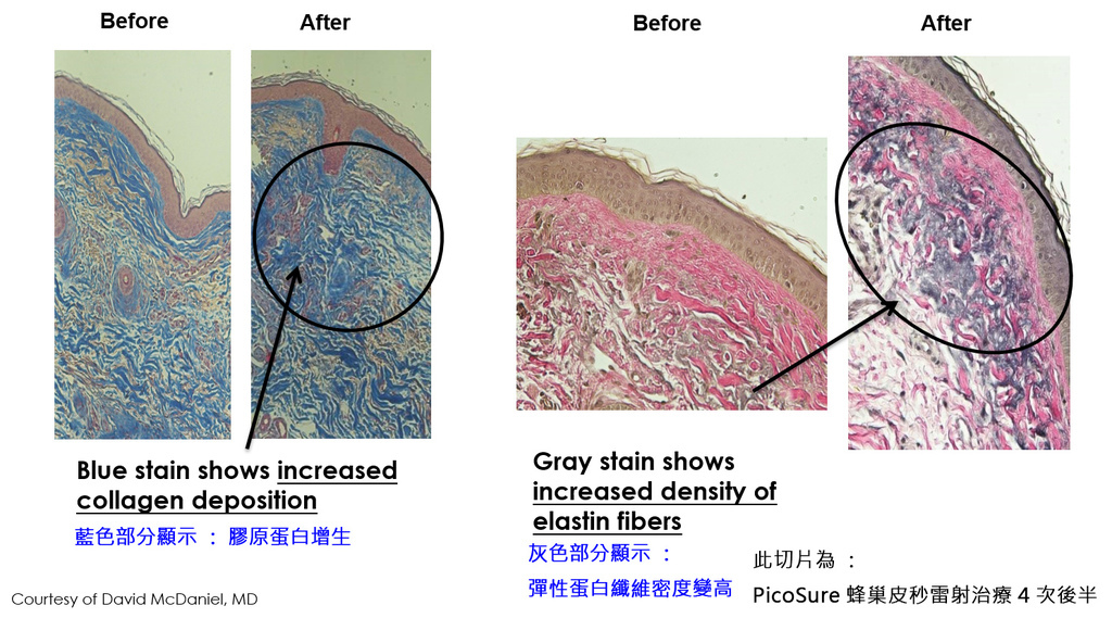 PicoSure755皮秒雷射蜂巢式雀斑曬斑除斑痘疤台北皮秒雷射推薦醫師皮膚科醫師痘疤凹疤飛梭雷射皮秒雷射價格副作用除斑凹洞淨膚雷射防曬推薦防曬乳曬黑紫外線(6).jpg