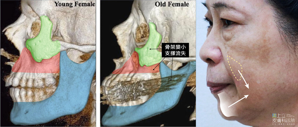 嘴邊肉是深層脂肪和骨架流失，所產生的「結構性」問題