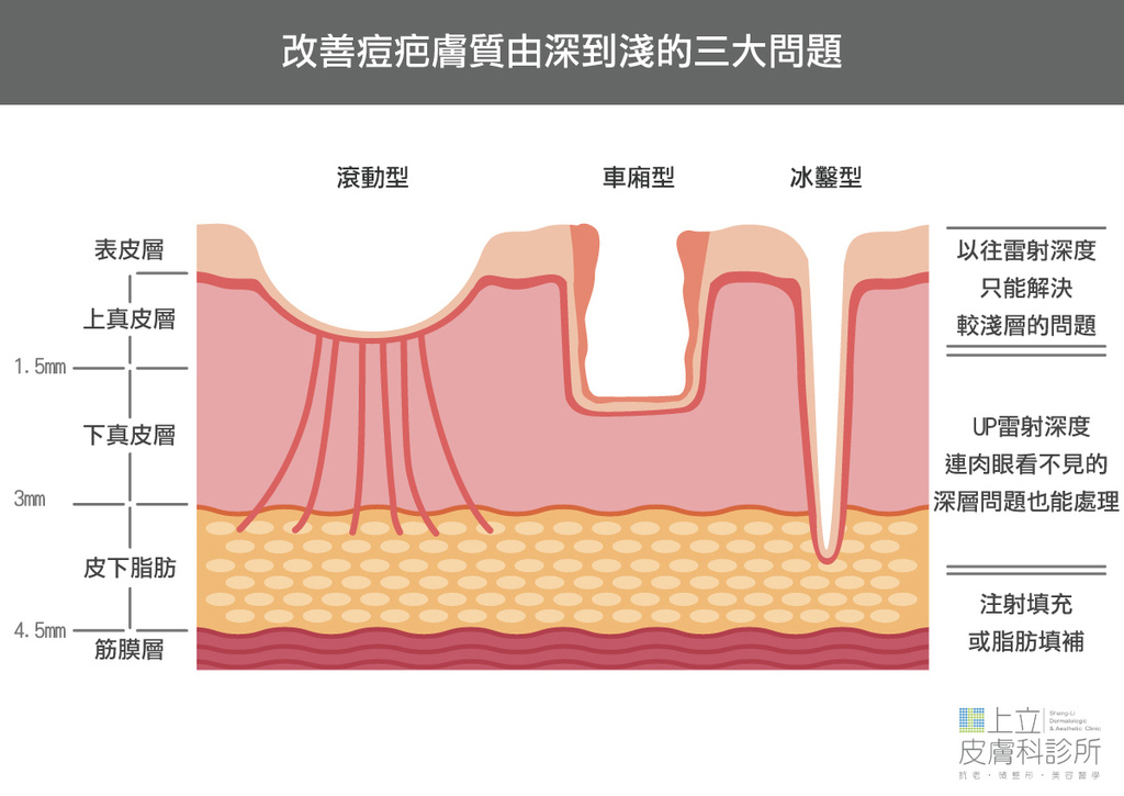 UP-laser-treatment-of-acne-scars-the-effect-must-be-better-than-Fraxel-laser (8).jpg