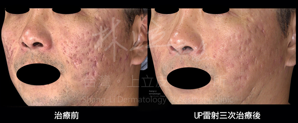 UP-laser-treatment-of-acne-scars-the-effect-must-be-better-than-Fraxel-laser (12).jpg