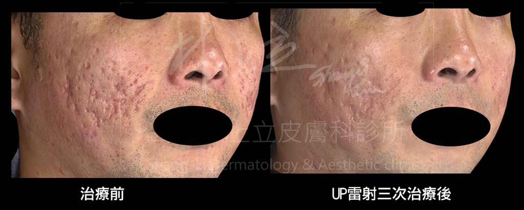 UP-laser-treatment-of-acne-scars-the-effect-must-be-better-than-Fraxel-laser (11).jpg