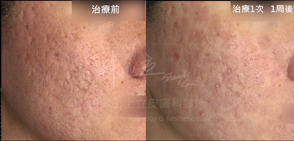 UP-laser-treatment-of-acne-scars-the-effect-must-be-better-than-Fraxel-laser (13).jpg