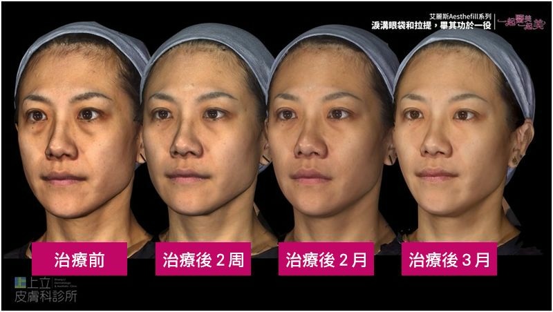 How-long-will-AestheFill-improve-the-depression-of-nasolabial-folds-to-see-the-effect (5).jpg