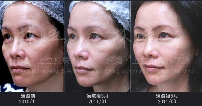 How-long-will-AestheFill-improve-the-depression-of-nasolabial-folds-to-see-the-effect (4).jpg