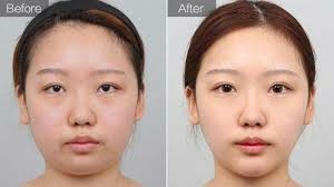 瘦臉6.jpeg 瘦臉6.jpeg