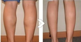 小腿溶脂.jpeg 小腿溶脂.jpeg