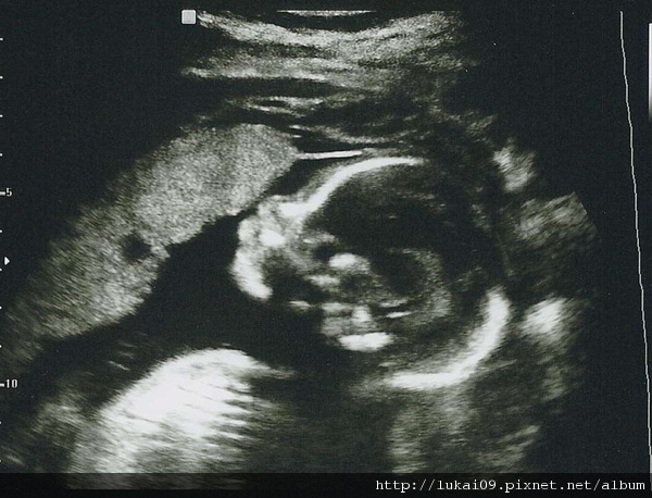 20 week Ultrasound - Head and Chest.jpg