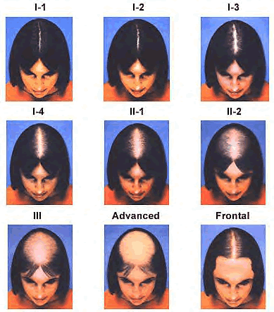 Ludwig scale(Female)