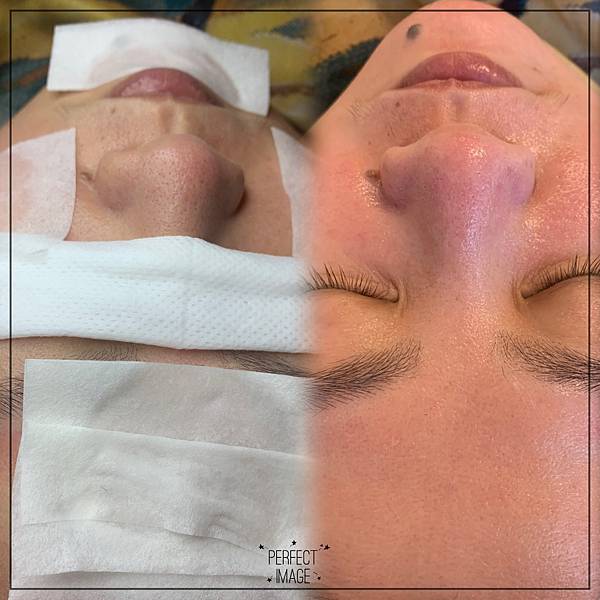 大小姐美容美體工作室_201118_13 高雄做臉清粉刺