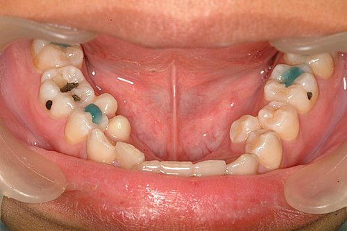 多生牙(上颚两中门牙间)supernumenary tooth (mesiodens)