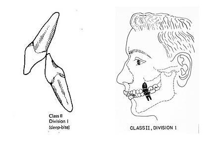 class-ii-angle-2