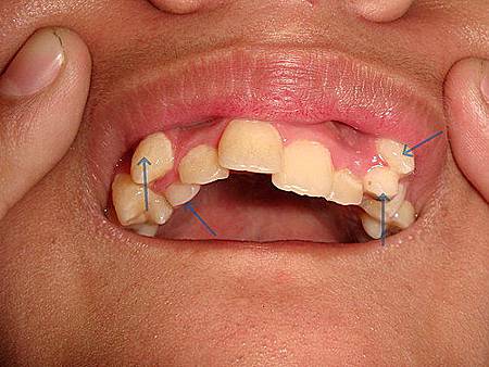 「混合齒列期崇愛牙醫」的圖片搜尋結果